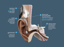 AB Cochlear Implant Candidate Guidebook